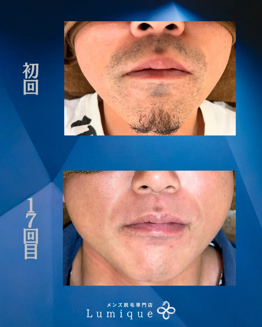 ヒゲ脱毛（口元・あご）の経過 初回と17回目の比較
