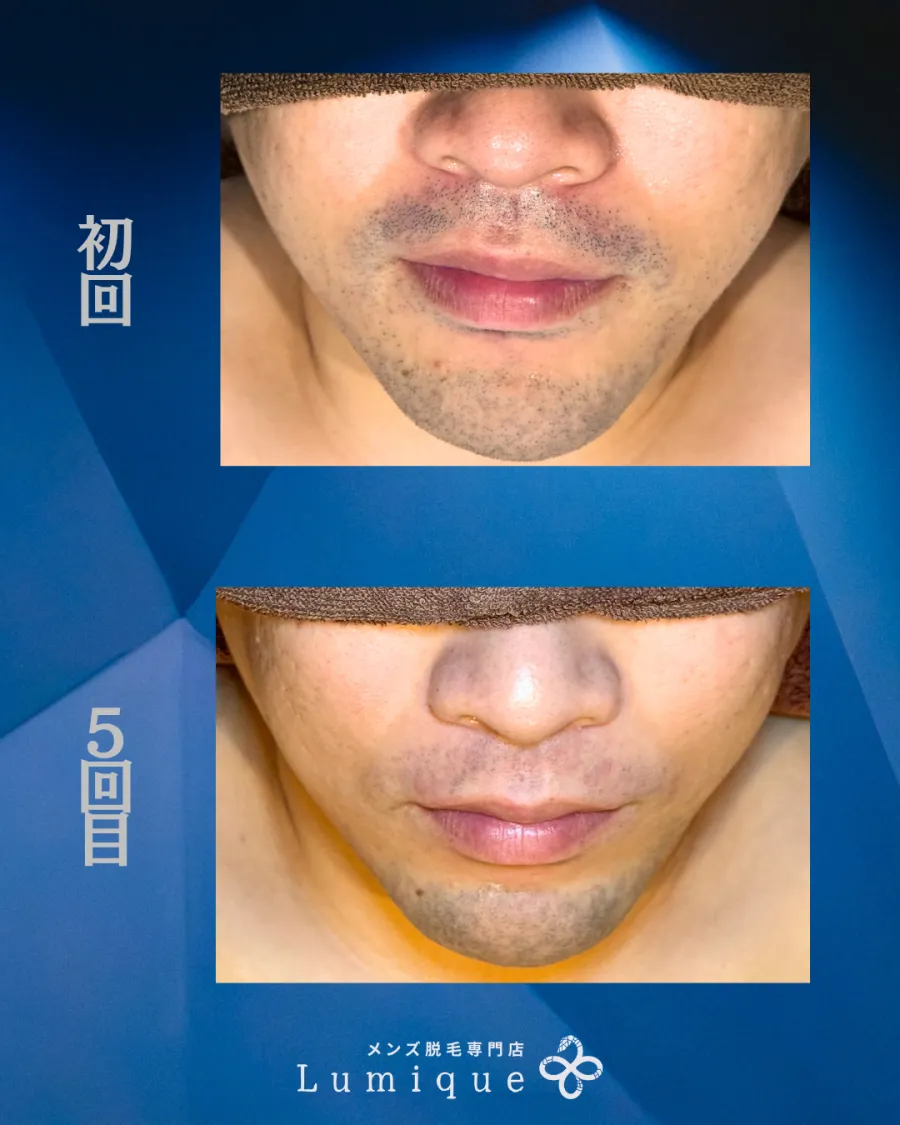 鼻下・口まわりのヒゲ脱毛の経過 初回と5回目の比較