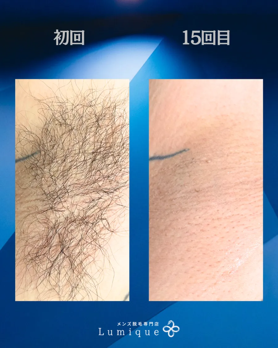 ワキの脱毛経過 初回と15回目の比較